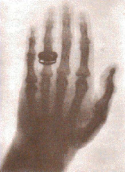 X izpien bidezko lehen argazkia (Wilhelm Conrad Roentgenen emaztearen eskua, 1895eko abenduaren 22a)