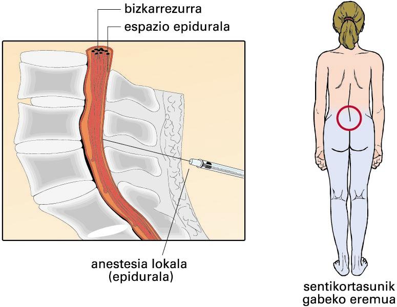 Anestesia epidurala