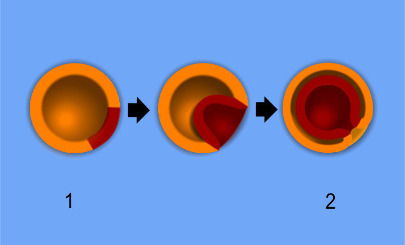 Diploblasto baten gastrulazioa: blastulatik (1), gastrula (2) eratzen da. Ektodermoko (laranja-koloreko geruza) zelula batzuk barnerantz biltzen dira, eta endodermoa eratu (geruza gorria)
