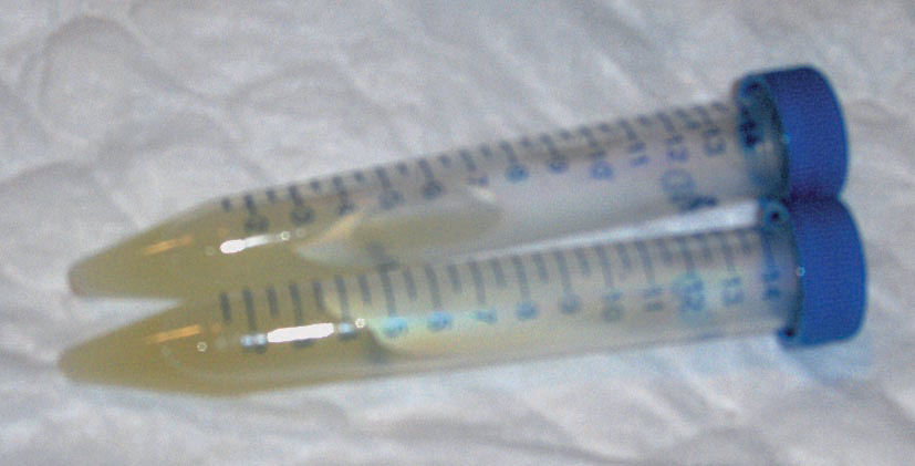 Likido zefalorrakideo iluna